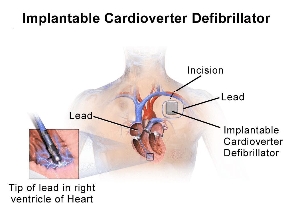 ICD Lead Diagram